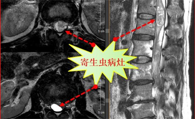 ​男子被诊断为脊髓内寄生虫感染，是何原因